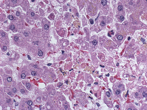 Liver from a 62-year-old woman (lung transplant patient) showing acute necrosis of hepatocytes and minimal inflammation. Randomly distributed single-cell necrosis, as observed in this patient, is a histopathologic feature observed in lymphocytic choriomeningitis virus infection. Original magnification ×400.