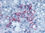 Thumbnail of Immunohistochemical staining of lymphocytic choriomeningitis virus antigens in a biopsy specimen of the transplanted liver from a 60-year-old woman, which demonstrates abundant and predominantly perimembranous staining of hepatocytes. Original magnification ×200.