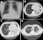 Thumbnail of Imaging studies of 42-year-old man with severe pneumonia caused by Legionella pneumophila serogroup 11, showing lobar consolidation of the left lower lung lobe, with an air-bronchogram within the homogeneous airspace consolidation. Consensual mild pleural effusion was documented by a chest radiograph (A) and high-resolution computed tomography (B). A week after hospital admission, repeat high-resolution computerized tomography of the chest showed extensive and homogeneous consolidat