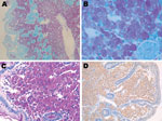 Thumbnail of Duodenal biopsy specimen from the patient with posttransplant cachexia. Ziehl–Neelsen acid staining of a patient biopsy specimen, showing partially reduced villous architecture at low magnification, with numerous Ziehl–Neelsen-positive macrophages within the lamina propria (A, original magnification ×50). High magnification clearly demonstrates mycobacteria as bacillary particles in the macrophage cytoplasm (B, original magnification ×400). C) Macrophages within the lamina propria a