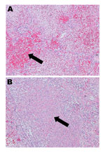 Thumbnail of Hematoxylin and eosin–stained lung tissue (original magnification ×10) from a patient in New Brunswick, Canada, with a fatal case of pneumonia caused by adenovirus 14. A) Arrow shows a patchy area of hemorrhagic consolidation. B) Arrow shows an area of necrosis.