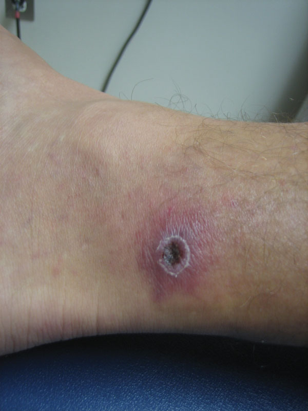 Acute eschar of patient who was subsequently diagnosed with Rickettsia parkeri infection in Pensacola, Florida, USA, in August 2011. This same eschar was unsheathed and swabbed after 14 days of antimicrobial drug treatment and had undergone significant healing. It still gave a positive result by real time PCR, although the convalescent-phase blood specimen showed a negative result.