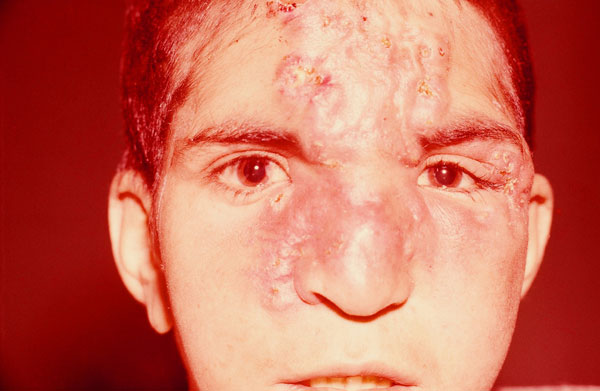 Disfiguring infiltration of the nose, glabella, and forehead with clustered nodules in left interciliary region of boy with endemic syphilis, Iran, 2010.