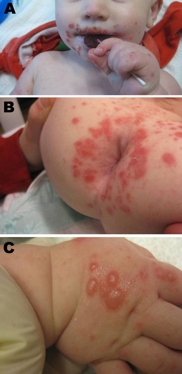 Manifestations of hand, foot, and mouth disease in patients, Boston, Massachusetts, USA, 2012. Discrete superficial crusted erosions and vesicles symmetrically distributed in the perioral region (A), in the perianal region (B), and on the dorsum of the hands (C).