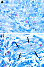 Thumbnail of Acid-fast organisms from biopsy specimens of a man with leprosy, United States. Fite-stained sections show numerous acid-fast bacilli in the initial skin biopsy (A) and in the biopsy taken at relapse, 6 years after completion of treatment (B). Both specimens demonstrate the clumps of Mycobacterium leprae referred to as globi. In panel B, bacilli can be seen within a cutaneous nerve (arrows), a finding that is pathognomonic of M. leprae. Original magnification ×1,000.
