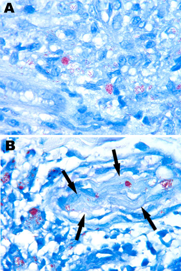 Acid-fast organisms from biopsy specimens of a man with leprosy, United States. Fite-stained sections show numerous acid-fast bacilli in the initial skin biopsy (A) and in the biopsy taken at relapse, 6 years after completion of treatment (B). Both specimens demonstrate the clumps of Mycobacterium leprae referred to as globi. In panel B, bacilli can be seen within a cutaneous nerve (arrows), a finding that is pathognomonic of M. leprae. Original magnification ×1,000.