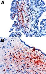 Thumbnail of Nipah virus (NiV) antigen in ferret infected with NiV-Malaysia. A) Choroid plexus endothelium. B) ependymal epithelium and subependymal tissue, including neurons. Rabbit α-NiV N protein antiserum. Original magnification ×200. 