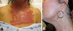 Thumbnail of A) Neck and chest of a 53-year-old woman (case-patient 1) 14 days after fractionated CO2 laser resurfacing. B) Neck of the patient after 5 months of multidrug therapy and pulsed dye laser treatment. 