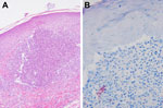 Thumbnail of Skin biopsy specimens of a 53-year-old woman (case-patient 1) after fractionated CO2 laser resurfacing. A) Hematoxylin and eosin–stained and B) Ziehl-Neelsen acid-fast–stained sections show a tiny superficial microabscess surrounded by sparse granulomatous inflammation. Several groups of acid-fast organisms can be seen at the lower left of panel B. Original magnifications: 400× in A and 600× in B. 