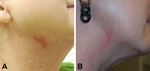 Thumbnail of A) Right lateral neck of a 52-year-old woman (case-patient 2) 9 days after fractionated CO2 laser resurfacing. B) Neck of the patient after 4 months of multidrug therapy.