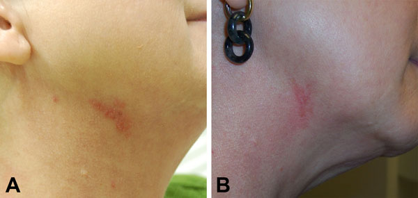 A) Right lateral neck of a 52-year-old woman (case-patient 2) 9 days after fractionated CO2 laser resurfacing. B) Neck of the patient after 4 months of multidrug therapy.