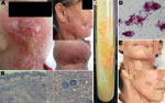 Thumbnail of Cutaneous Mycobacterium shigaense infection in a 56-year-old Immunocompetent woman, China. A)  Plaques, scars with scabbing, nodules, and concave scars on the face and neck and papules and scarring on the submaxilla. B) Histopathologic results, showing hyperplastic epidermis and infiltration with lymphocytes, neutrophilic leukocytes, multinuclear giant cells, and epithelioid cells in the dermis. C) Samples streaked  on Löwenstein–Jensen medium at 32°C formed smooth, yolk yellow crea