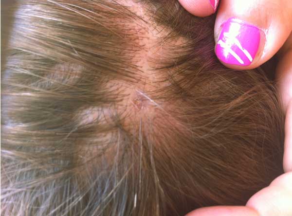 Residual alopecia 10 weeks after tick bite in 13-year-old boy with scalp eschar and neck lymphadenopathy caused by Rickettsia massiliae. Printed with permission from N.C. (photographer and author) and from parents of the patient. 