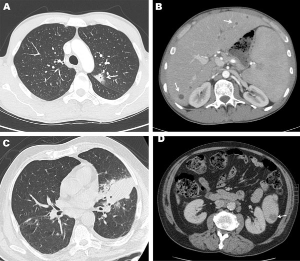 Computed tomography (CT) images of the chest and abdomen of case-patient 1 showing A) a subpleural nodular and cavitary lesion (arrow) in the left upper lobe of the lung and B) multiple small round liver abscesses and enlargement of the spleen and multiple foci of ill-defined areas of hypoattenuation (arrows). CT images of the chest and abdomen of case-patient 2 showing C) a focal area of parenchymal consolidation in the left lung associated with an ipsilateral mild pleural effusion and D) and a