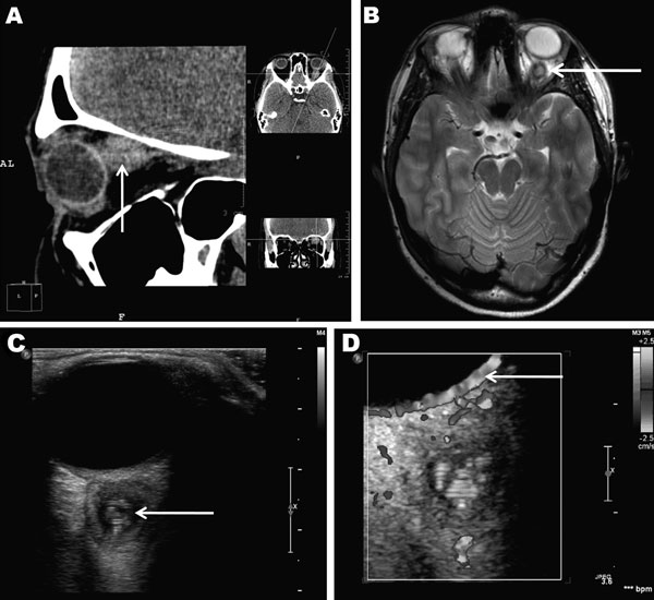 Retroocular nodule of a Dirofilaria repens worm detected in a 20-year-old woman, Rostov-na-Donu, Russia. The cyst (arrows) is shown by computed tomography scan (A) and magnetic resonance imaging (B). Ultrasonography images (C) show a worm-like structure inside the cyst (arrow), and color Doppler imaging (D) shows marginal vascularization of the lesion).