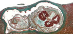 Thumbnail of Oblique cross-section of liver of a patient (immigrant) from Togo, showing a well-preserved Armillifer armillatus nymph in a subcapsular location. The annulated parasite is encapsulated by its shed cuticle (exuvia) and dense fibrosis. Consistent with the viable type of a pentastomid lesion (3), no inflammatory infiltrate is visible. This image also shows internal structures of the pentastome, such as prominent bunches of acidophilic glands surrounding the intestine (Masson’s trichro
