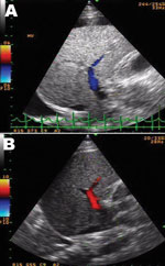 Thumbnail of Ultrasonograph with color flow Doppler image of the liver of a 10-year-old boy with liver failure associated with dengue virus infection. A) Day 2 of hospitalization, showing reversed direction of blood flow in the right branch of the portal vein (hepatofugal flow). There was diffuse increased liver parenchymal echo, swelling of the gallbladder wall, and right pleural effusion. B) Day 5 of hospitalization, showing returning normal direction of portal venous flow (hepatopetal flow). 