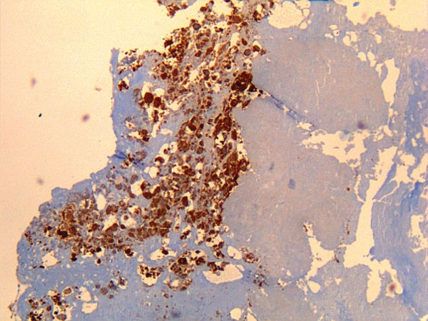 Immunohistochemical detection of Coxiella burnetii in resected cardiac valve of a 60-year-old man with Q fever endocarditis, Cayenne, French Guiana. Monoclonal antibody against C. burnetii and hematoxylin were used for staining. Original magnification ×50.