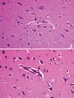 Thumbnail of Brain tissue of an unvaccinated control pig (A) and pig inoculated with pseudorabies virus strain HeN1 (B). Arrows indicate lymphocyte infiltration around the small blood vessels in the brain cortex. Original magnification ×100.