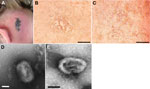 Thumbnail of Cowpox virus infection in 4 persons in France. The case-patients were infected in 2011 by virus transmitted from infected pet rats. A) Cutaneous lesion on patient 1. B) Cytopathic effects observed on Vero cell monolayers with isolate CEPAD332. Scale bar represents 500 μm. C) Cytopathic effects observed on Vero cell monolayers with isolate CEPAD335. Scale bar represents 500 μm. D) Negative-staining electron microscopy image of isolate CEPAD332. Scale bar represents 100 nm. E) Negativ