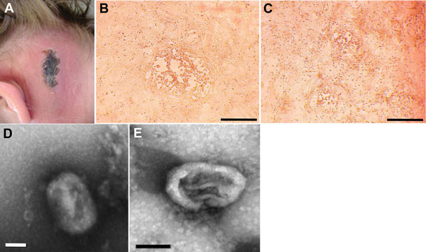 Cowpox virus infection in 4 persons in France. The case-patients were infected in 2011 by virus transmitted from infected pet rats. A) Cutaneous lesion on patient 1. B) Cytopathic effects observed on Vero cell monolayers with isolate CEPAD332. Scale bar represents 500 μm. C) Cytopathic effects observed on Vero cell monolayers with isolate CEPAD335. Scale bar represents 500 μm. D) Negative-staining electron microscopy image of isolate CEPAD332. Scale bar represents 100 nm. E) Negative-staining el