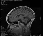 Thumbnail of Magnetic resonance image of a 13-year-old boy in Uganda with nodding syndrome. Image shows prominent cortical atrophy.