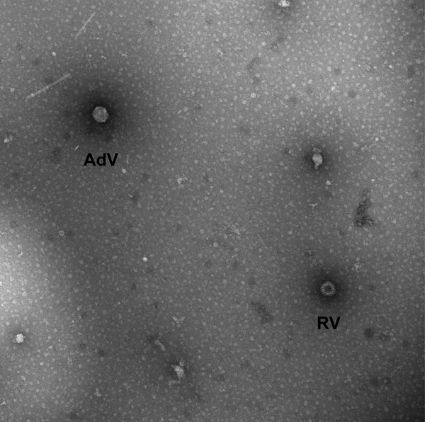 Transmission electron micrograph image of stool sample from 36-month-old child with diarrhea, showing viral particles characteristic of rotavirus (RV) and enteric adenovirus (AdV). Magnification ×92,300. Image courtesy of Charles Humphrey.