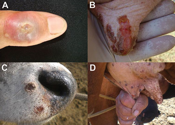 Exanthematic lesions caused by vaccinia virus (VACV) infection during this outbreak. A) Vesicular lesion on milker’s finger that advanced to an ulcerative stage. B and D) Typical lesions on teats and udder of a dairy cow infected by VACV at different stages, ranging from ulceration to scabs. C) Lesions on a calf’s muzzle probably caused by VACV infection during suckling.