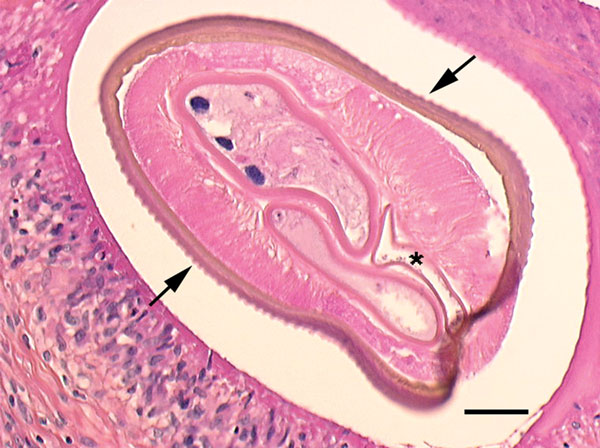 Cross-section of the filarial nematode seen in the subcutaneous nodule on the thigh of a woman in France. The features, as described in the original report (1), include prominent, longitudinal ridging of the cuticle (arrows), 2 reproductive tubes, and the intestine (asterisk). Scale bar indicates 50 µm. Image courtesy of Jean-Philippe Dales.