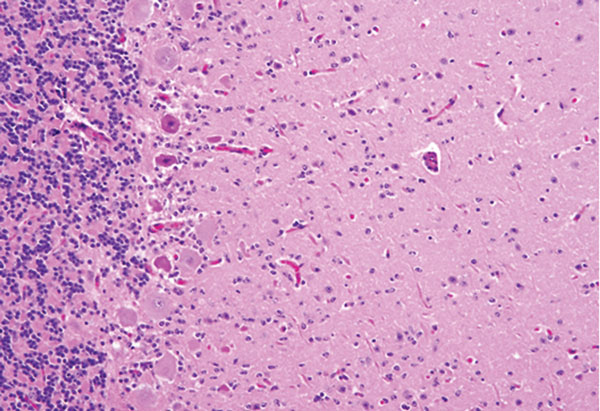 Dorsal root ganglion of a heifer with encephalomyelitis (animal 2). Multifocal marked interstitial lymphocyte, macrophage, and plasma cell infiltrates with multifocal neuronal degeneration and necrosis can be seen. Hematoxylin and eosin stain. Original magnification ×400.
