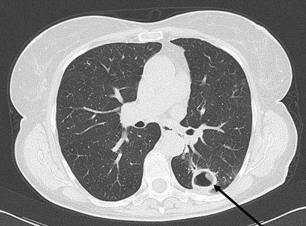 Computed tomography scan showing a cavity (arrow) in the left lung of a 74-year-old woman (patient 1) in Italy. Laboratory testing suggests that the woman was infected with Mycobacterium yongonense.