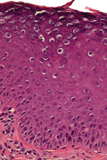 Thumbnail of Histopathologic findings for a representative biopsy of skin lesions (erythematous warts) from a female patient before she was administered human papillomavirus vaccine. Analysis revealed features typical of benign cutaneous warts, including acanthosis, parakeratosis, and numerous koilocytes. Vacuolated granular cells show prominent keratohyalin granules, characteristic of human papillomavirus infection (hematoxylin-eosin staining; original magnification ×200).