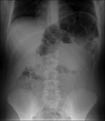 Thumbnail of Abdominal radiograph of a 13-year-old boy with congenital Chagas disease, Japan, showing megacolon and marked dilatation at the splenic flexure.