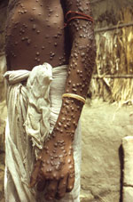 Thumbnail of Patient with smallpox. Photograph by Jean Roy, provided by the Public Health Image Library, Centers for Disease Control and Prevention, Atlanta, GA, USA. 