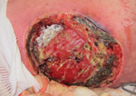 Thumbnail of Necrotizing cutaneous mucormycosis, Joplin, Missouri, USA, 2011 (4). A left flank wound in a mucormycosis case-patient, with macroscopical fungal growth (tissue with white, fluffy appearance) and necrotic borders before repeated surgical debridement. Copyright 2012 Massachusetts Medical Society. Reprinted with permission.