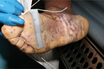 Thumbnail of Postmortem purpuric rash on sole of a man for whom invasive meningococcal disease was diagnosed after death (case 1), New York City, New York, USA.