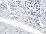 Thumbnail of Immunostaining of Neisseria menigitidis in meninges of a man for whom invasive meningococcal disease was diagnosed after death (case 2), New York City, New York, USA. Naphthol fast red substrate with light hematoxylin counterstain. Original magnification ×25.