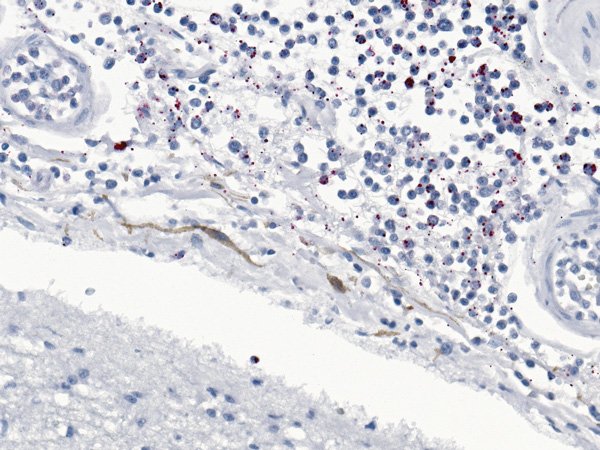 Immunostaining of Neisseria menigitidis in meninges of a man for whom invasive meningococcal disease was diagnosed after death (case 2), New York City, New York, USA. Naphthol fast red substrate with light hematoxylin counterstain. Original magnification ×25.
