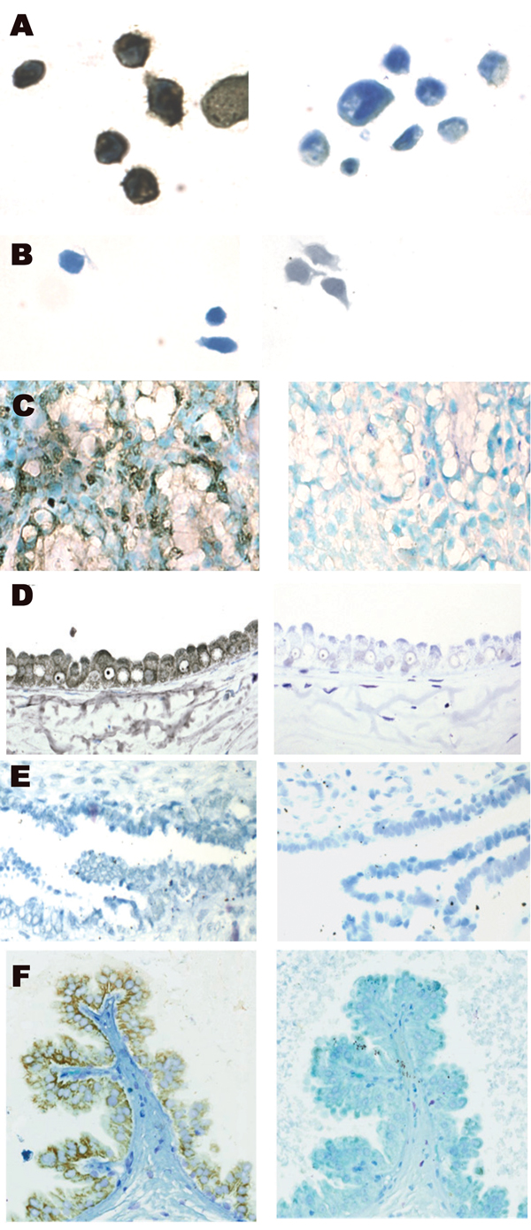 Localization of bovine leukemia virus (BLV) in human breast tissue and bovine mammary epithelium samples detected by in situ PCR for the BLV tax region and immunohistochemical testing for p24 capsid protein. A) BLV-positive fetal lamb kidney (FLK) cell line. Brown at left indicates positive diaminobenzidine endpoint immunoperoxidase reaction to detect digoxygenin incorporated into PCR product within FLK cells. FLK cells reacted with PCR reaction mix without primers (right) to check for false-pos