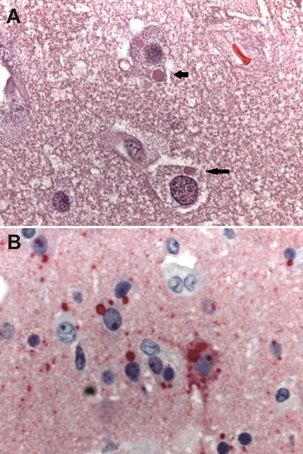 Photomicrographs showing histopathologic features and immunolocalization of rabies virus antigens in central nervous system tissue from a kidney transplant recipient with donor-derived rabies infection. A. Typical intracytoplasmic eosinophilic inclusions (Negri bodies, arrows). Hematoxylin and eosin staining. Original magnification, ×158. B) Rabies virus antigens within neurons and neuronal processes. Immunoalkaline phosphate staining, naphthol fast red substrate with light hematoxylin counterst