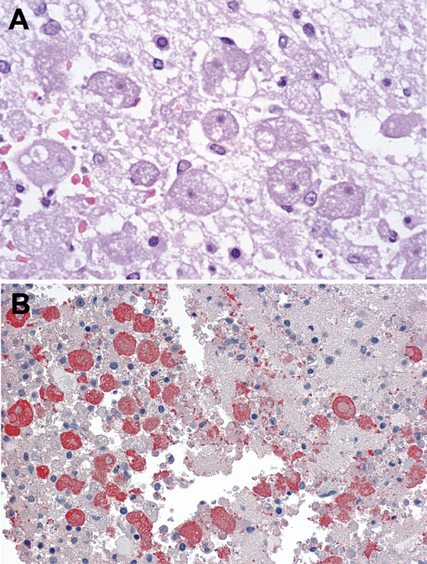 Photomicrographs showing histopathologic features and immunolocalization of Balamuthia mandrillaris antigens in central nervous system tissue from a donor with B. mandrillaris infection. A) Typical amebic trophozoites with prominent karyosomes in central nervous system. Hematoxylin and eosin staining. Original magnification, ×158. B) B. mandrillaris antigens in amebic trophozoites. Immunoalkaline phosphate staining, naphthol fast red substrate with light hematoxylin counterstain. Original magnif