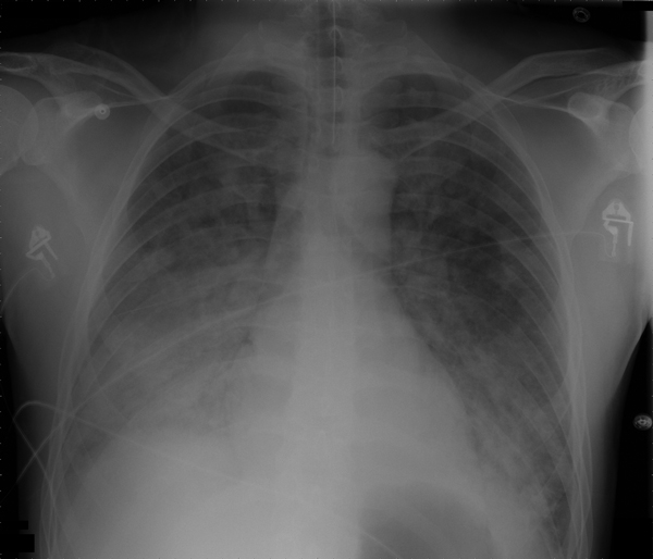 Chest radiograph of 40-year-old man with acute respiratory distress syndrome as a complication of murine typhus.