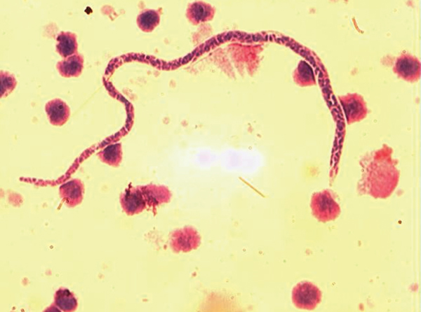Mansonella perstans nematode in peripheral blood mononuclear cells from Buruli ulcer patient in Ghana. Cells were stained with Giemsa (original magnification ×1,000). M. perstans nematodes can be distinguished from Loa loa and Wuchereria bancrofti nematodes by relative small size, detection in blood samples obtained during the day, and lack of a sheath. 