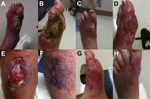 Thumbnail of Progression of lesions caused by Mycobacterium ulcerans infection before, during, and after treatment. A–C) Left foot before treatment. D) Left lower leg during treatment. E) Right calf before treatment. F) Right calf after treatment. G, H) Left foot after treatment.