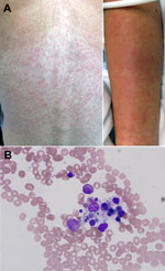 Thumbnail of A) Maculopapular eruption observed on the back and arms of 25-year-old female wildlife biologist infected with a novel paramyxovirus related to rubula-like viruses isolated from fruit bats, on hospitalization day 2. B) Bone marrow biopsy sample showing macrocytic hemophagocytosis (possible granulocyte infiltration).