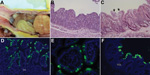 Thumbnail of Changes seen, by macroscopic examination, histologic examination, or immunofluorescence staining in the intestine of gnotobiotic pigs inoculated with porcine epidemic diarrhea virus (PEDV; US strain PC21A). A) Intestine of pig 1 at postinoculation hour (PIH) 30 (4–5 h after onset of clinical signs), showing thin and transparent intestinal walls (duodenum to colon) and extended stomach filled with curdled milk. B) Hematoxylin and eosin (H&amp;E)–stained jejunum of pig 3 at PIH 46 (at