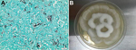 Thumbnail of Histopathologic findings from a 34-year-old man with X-linked gp91phox gene mutation chronic granulomatous disease. A) Liver biopsy results showing numerous irregular and nonseptate hyphae with bulbous dilations. Gomori methenamine silver stain. Original magnification ×400. B) Culture of Mortierella wolfii, after 3-days of incubation at 30°C on Sabouraud agar medium.