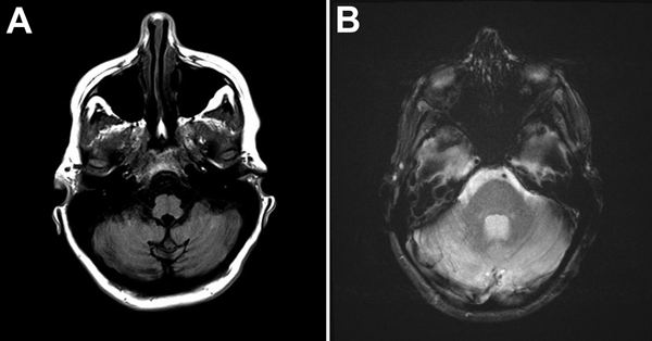 A) Magnetic resonance images of the brain of a woman with cerebellitis associated with influenza A(H1N1)pdm09, United States, 2013. T1-weighted axial MRI brain sequence showing hypo-intensity of bilateral cerebellar hemispheres. B) T2-weighted axial MRI brain sequence showing hyperintensity of bilateral cerebellar hemispheres.