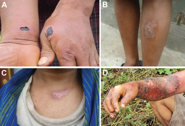 Cutaneous anthrax with typical black eschars on the hand and wrist (A), leg (B), and neck (scar) (C); and severe inflammation of the arm (D) of persons who had contact with Bacillus anthracis–infected animals and carcasses, Bhutan 2010.