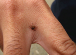 Thumbnail of An adult male Amblyomma aureolatum tick attached to the hand of a person who became infested while in direct contact with a naturally infested dog in the metropolitan area of São Paulo, Brazil.